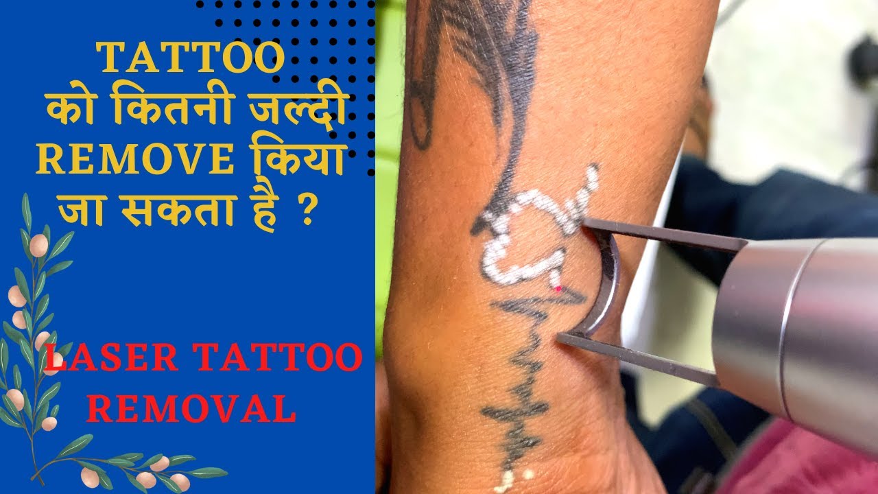 Laser Tattoo Removal | Tattoo को जल्दी निकाल ने का तारिका / fastest tattoo removal method/ Dr Uttam