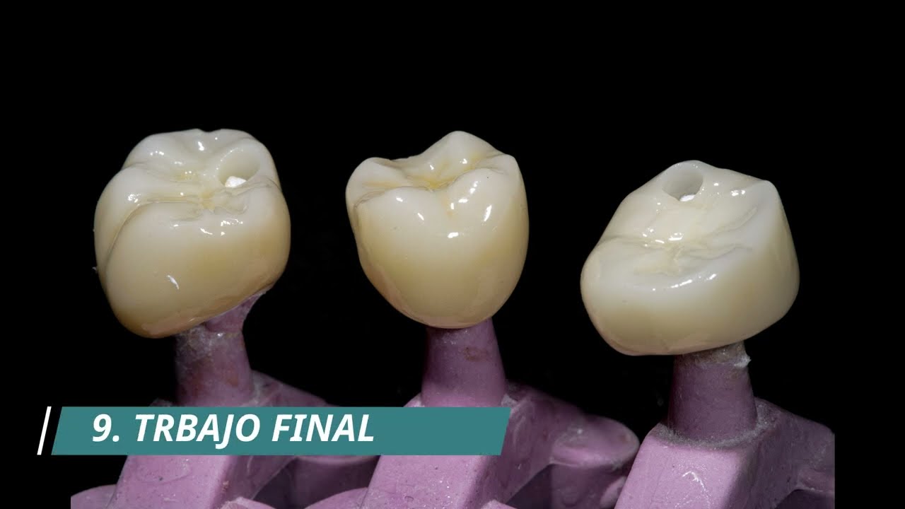Corona Dental Disilicato de Litio - Diseño, fresado y pulido - Proceso completo