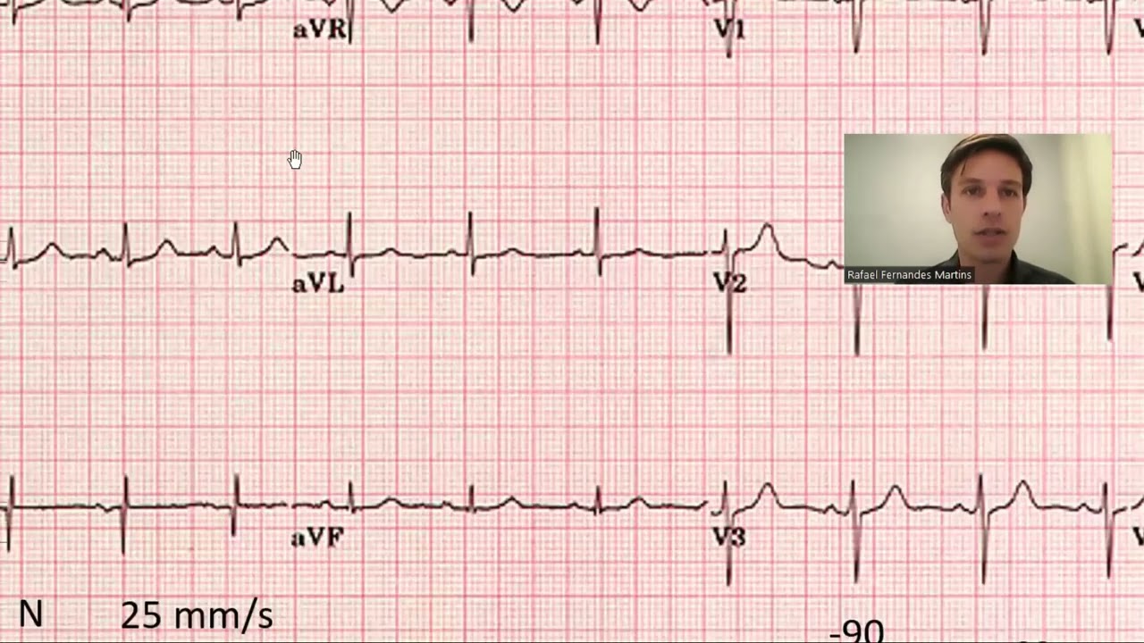 Como laudar um eletrocardiograma 4/4 (praticando)