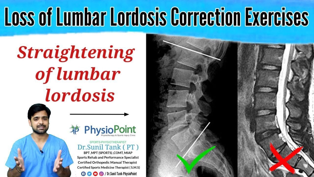 Straightening of lumbar lordosis | loss of lumbar lordosis exercises in hindi | Dr. Sunil Tank