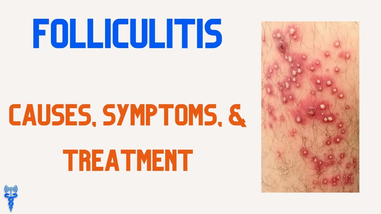 FOLLICULITIS Causes, Symptoms, & Treatments