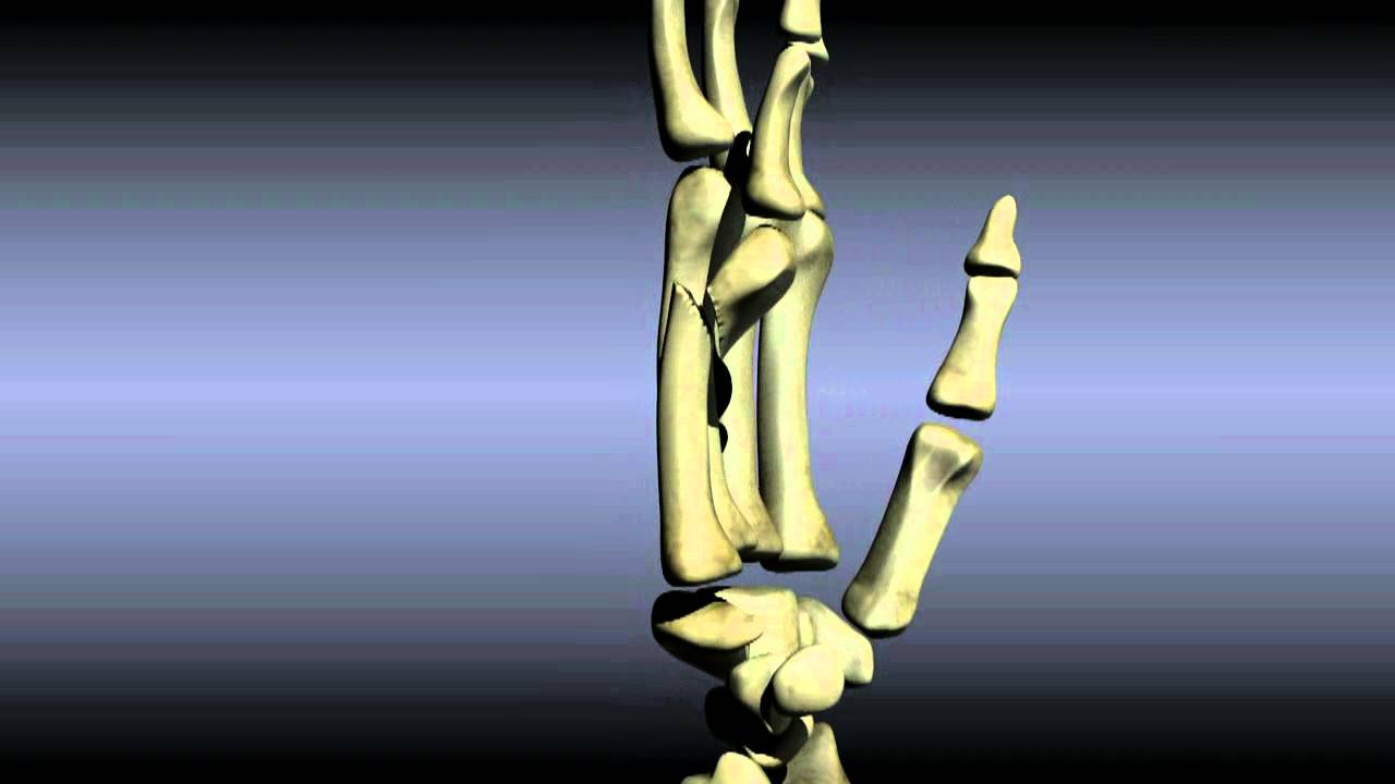 Reducing a Boxer's Fracture