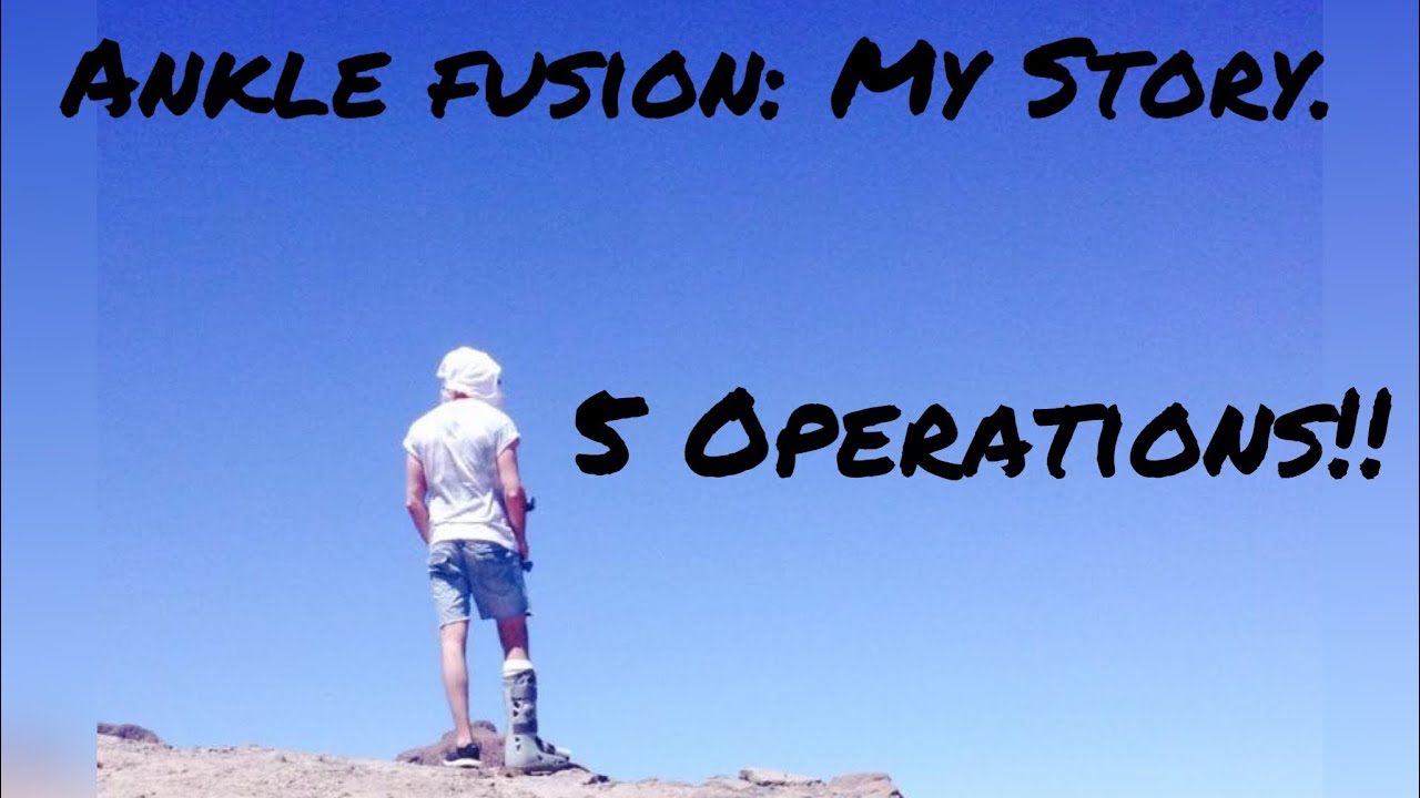 Ankle Fusion: MY STORY!