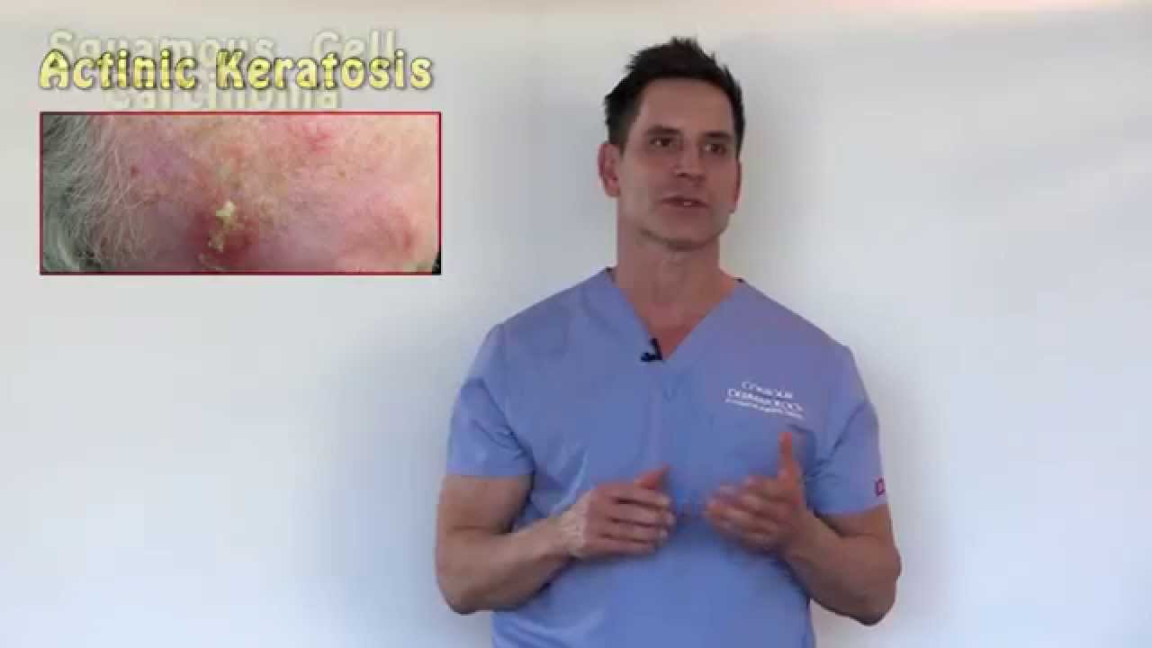 Pre-Cancers or Actinic Keratosis Treatment Options With Dr. Timothy Jochen