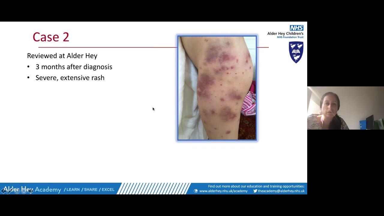 GPLS - Henoch-Scholein Purpura (IgA Vasculitis)