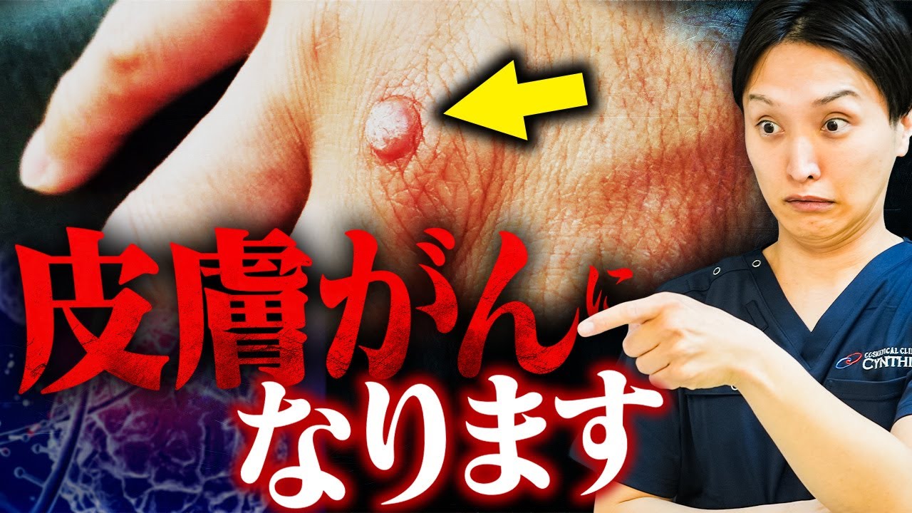 【皮膚科専門医が解説】ウィルス性のイボは放っておくと皮膚がんになります。