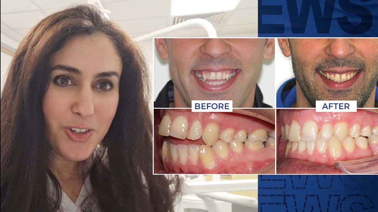 Anterior Open Bites! Causes, Treatment Plus Patient Testimonial!
