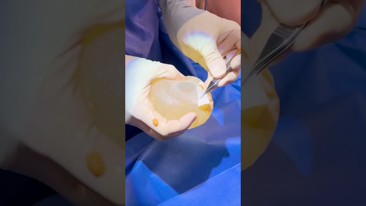 41 Year Old Breast Implants - The Oldest I&rsquo;ve Ever Seen #BreastImplants