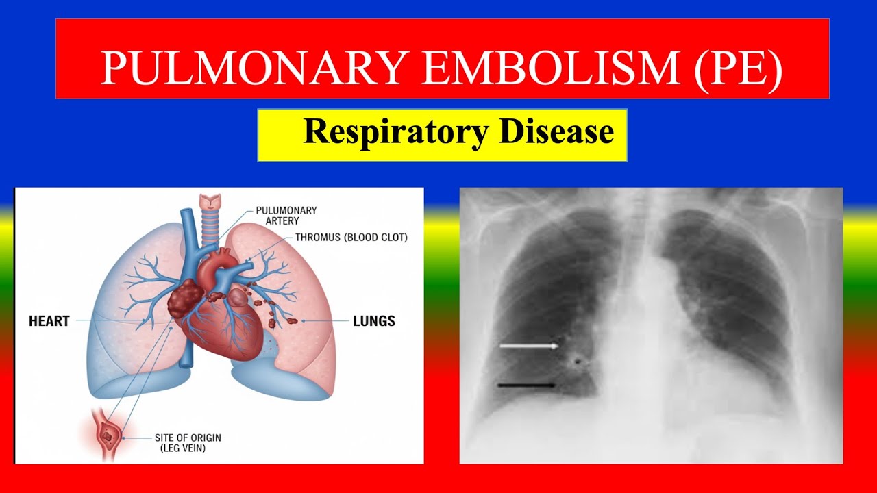 PULMONARY EMBOLISM (PE) Explained | Causes, Symptoms, Diagnosis & Treatment
