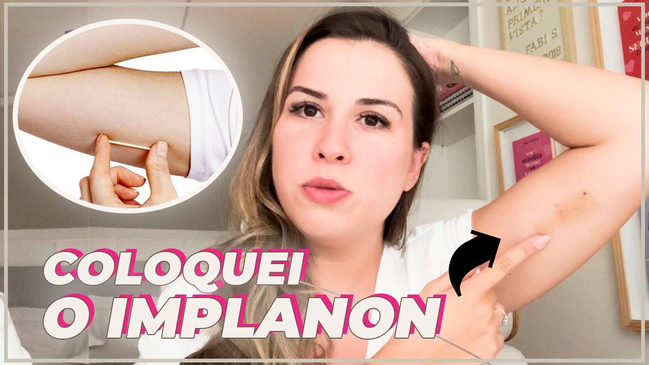 MEU NOVO MÉTODO CONTRACEPTIVO: CHIP ANTICONCEPCIONAL IMPLANON + COMO FUNCIONA?