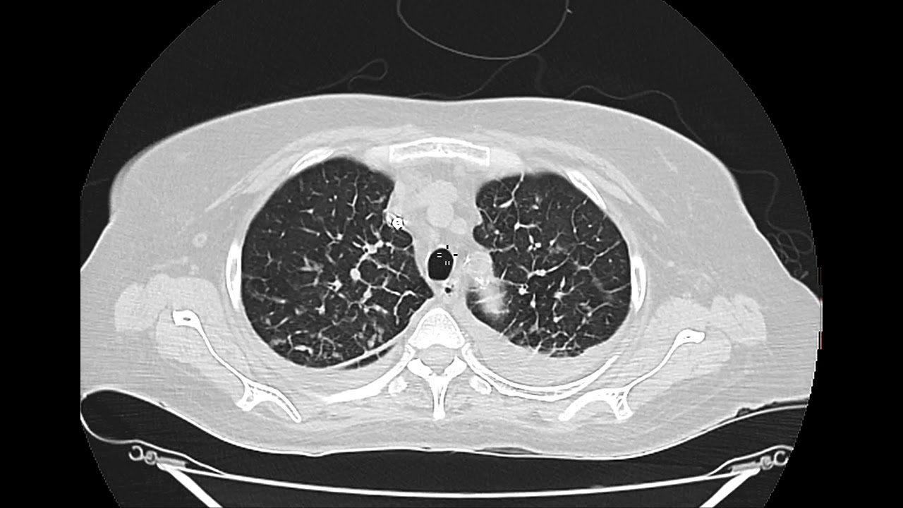TC TORAX LINFANGITE CARCINOMATOSA