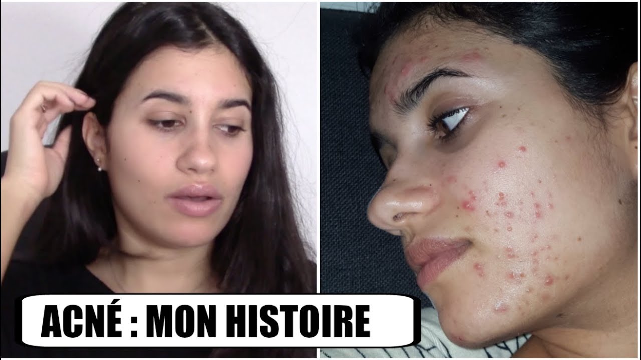 ACNÉ & ROACCUTANE : MON HISTOIRE