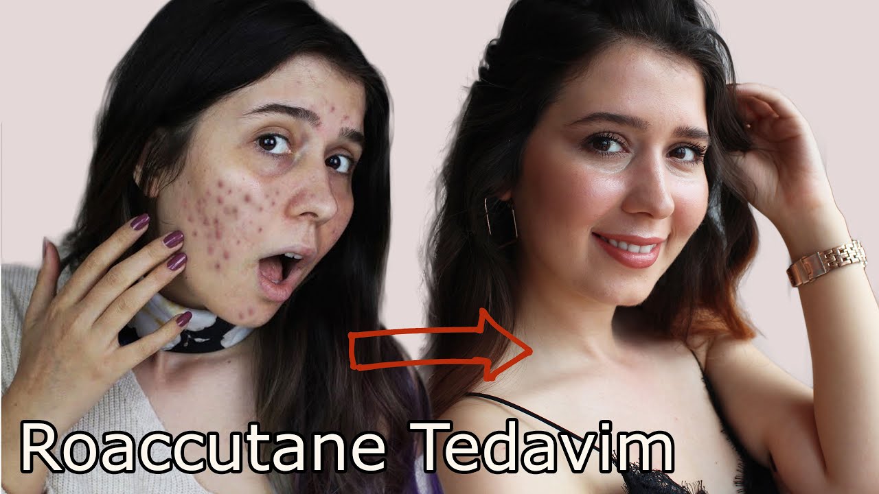 FOTOĞRAFLARLA 30 GÜNDE CİLDİMİN DEĞİŞİMİ! 😱
