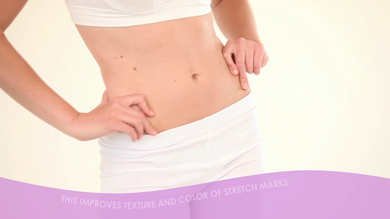 Laser Stretch Marks Removal @ Iconic