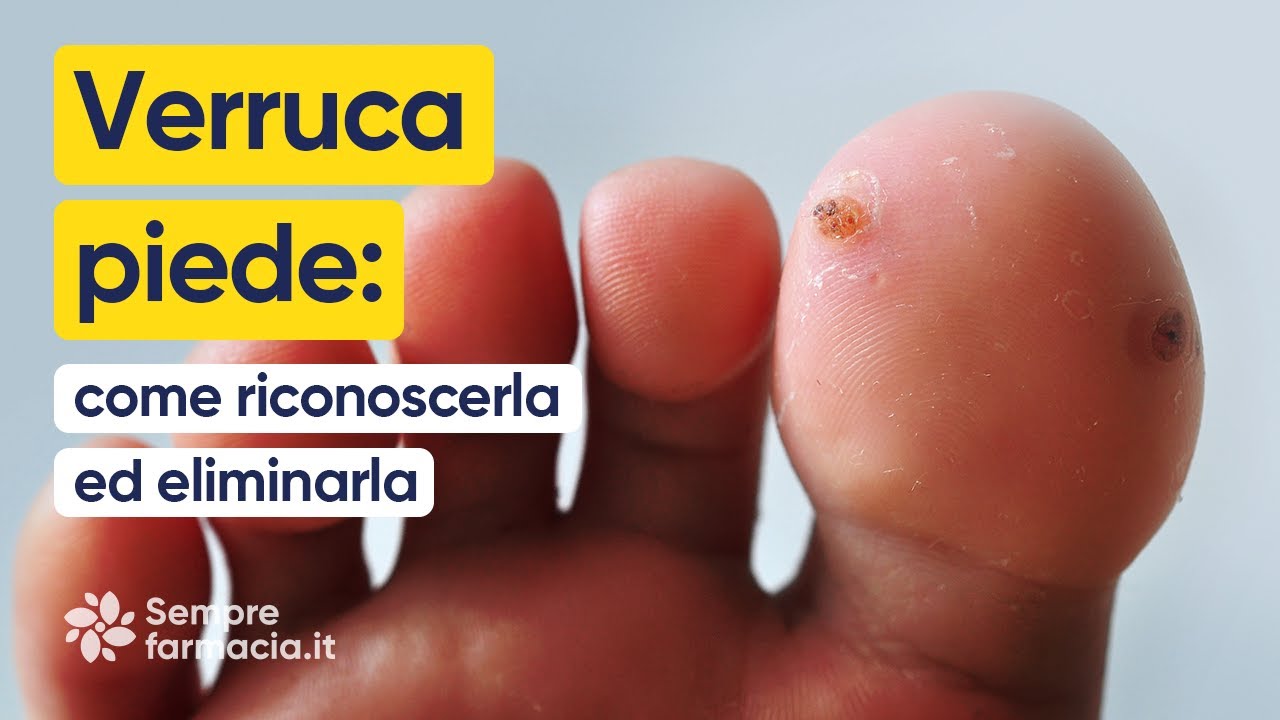 Verruca piede: come riconoscerla ed eliminarla