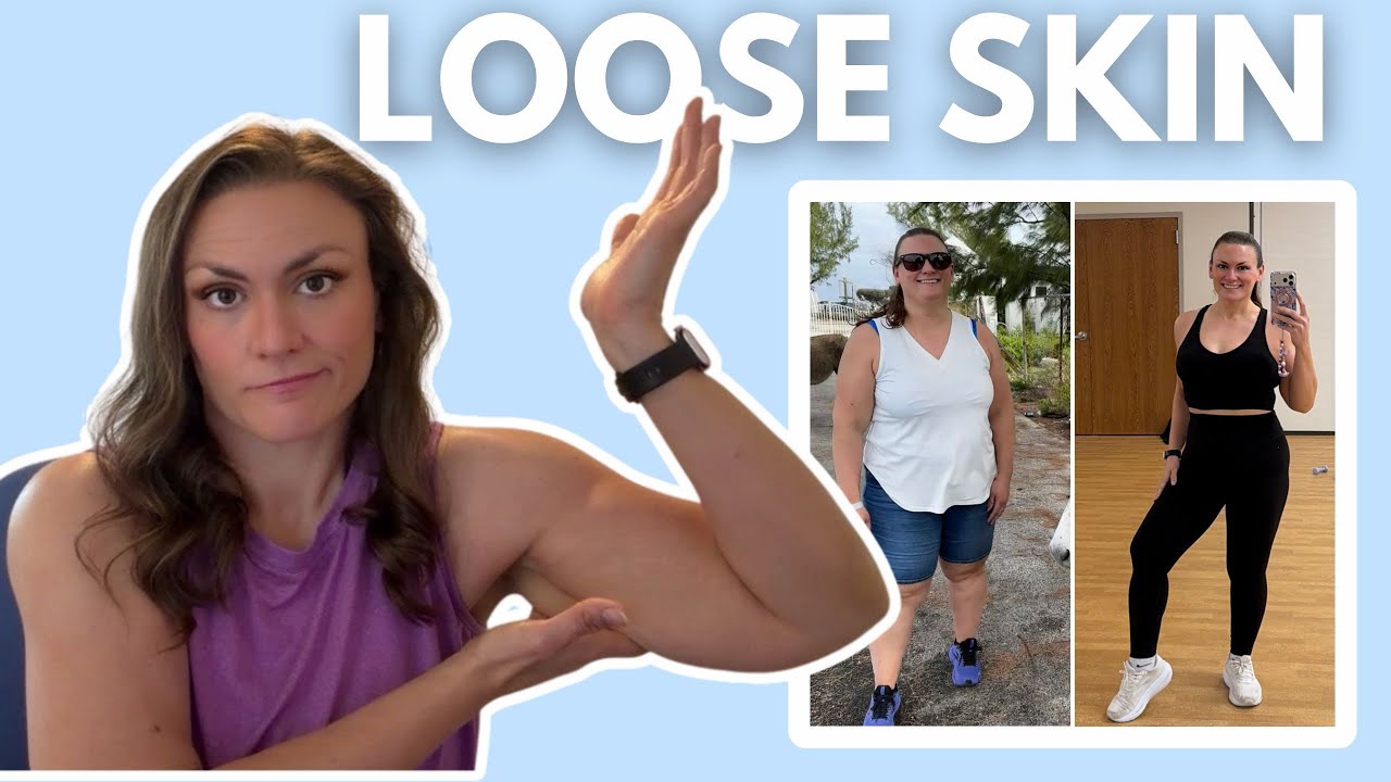 Loose Skin After Extreme Weight Loss: What Can We Do About It? 