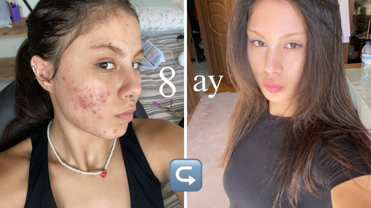 ROACCUTANE HAYATIMI KURTARDI / süreçte yaşadıklarım