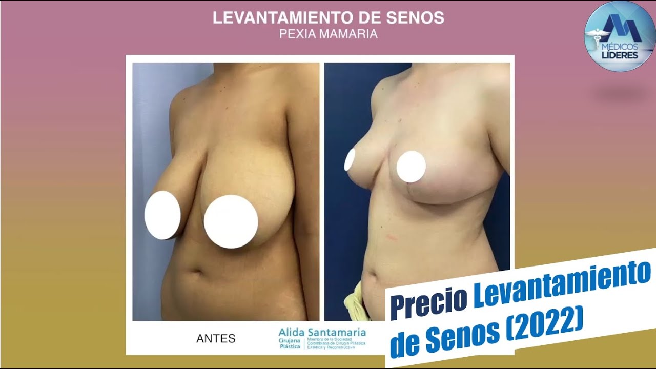 Pexia mamaria para pacientes extranjeros (Precios exactos en 2022) Recomendaciones Alida Santamaría