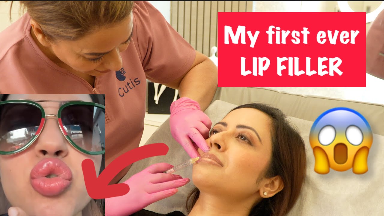 OMG I got a Lip Filler | Process, Journey, Result, Before and After | Garima&rsquo;s Good Life