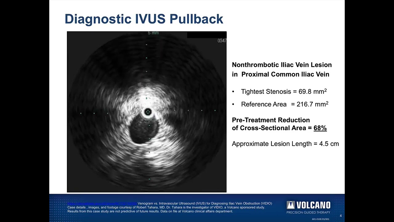 IVUS-Guided Deep Venous Stenting