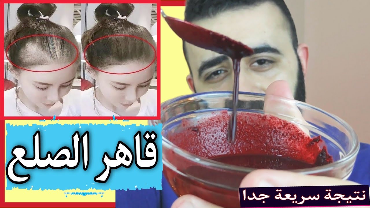 خبر مفرح عن اكتشاف مقاوم طبيعي للصلع و انبات الشعر نتيجة سريعة جدا و اقوي من سبيرولينا و الروزماري