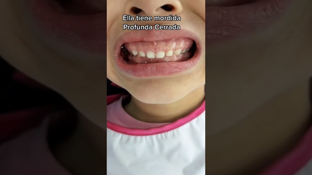 Niña expandiendo los huesos maxilares con ayuda de la Ortopedia Funcional de los Maxilares.