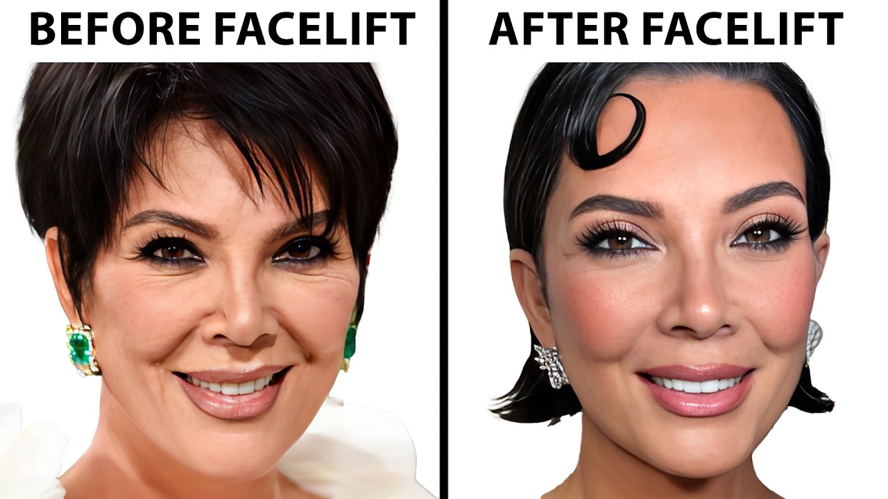 Facelifts Have Changed... Here's How