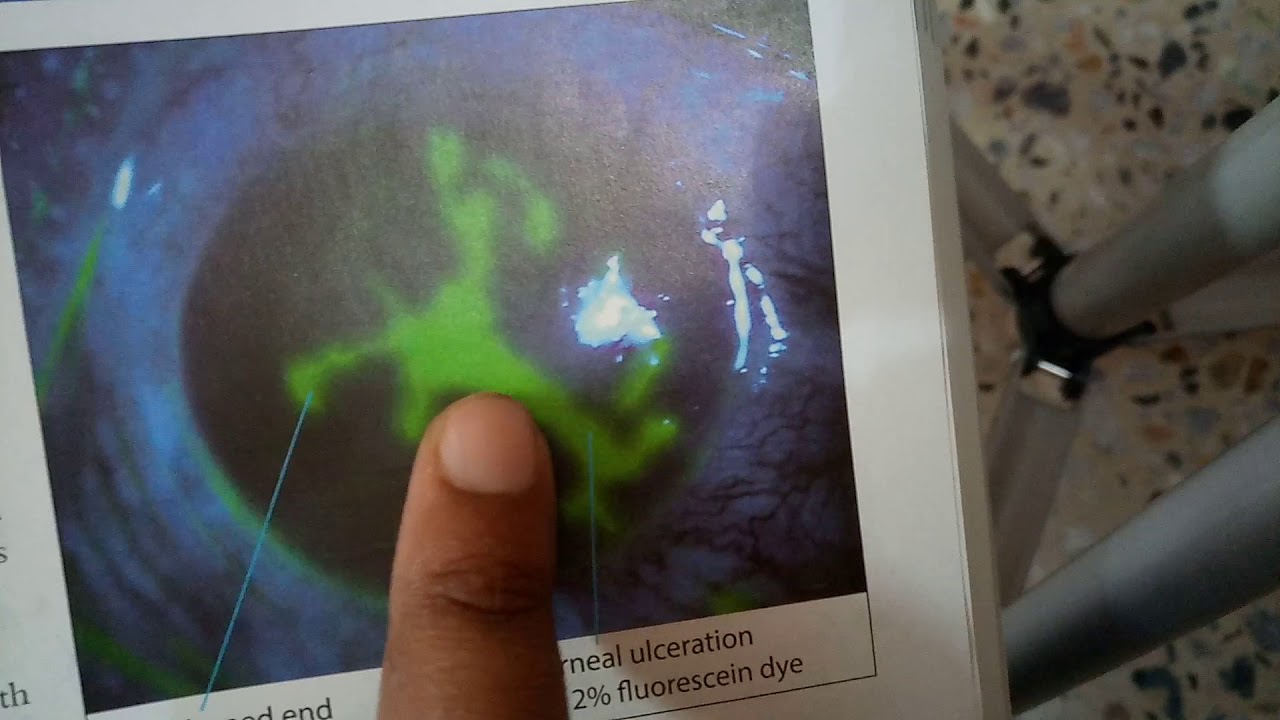 HERPES SIMPLEX KERATITIS or DENDRITIC ULCER or GEOGRAPHIC ULCER verrry IMPORTANT made easy