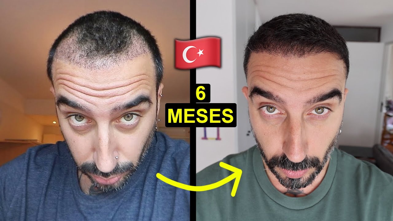 mi Transplante Capilar 6 meses después | toda la verdad y resultados reales