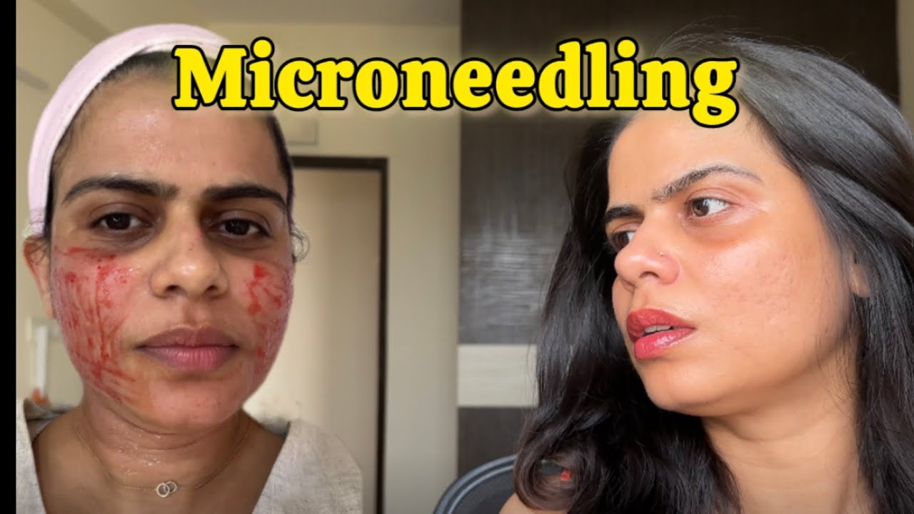 I Tried Microneedling✨