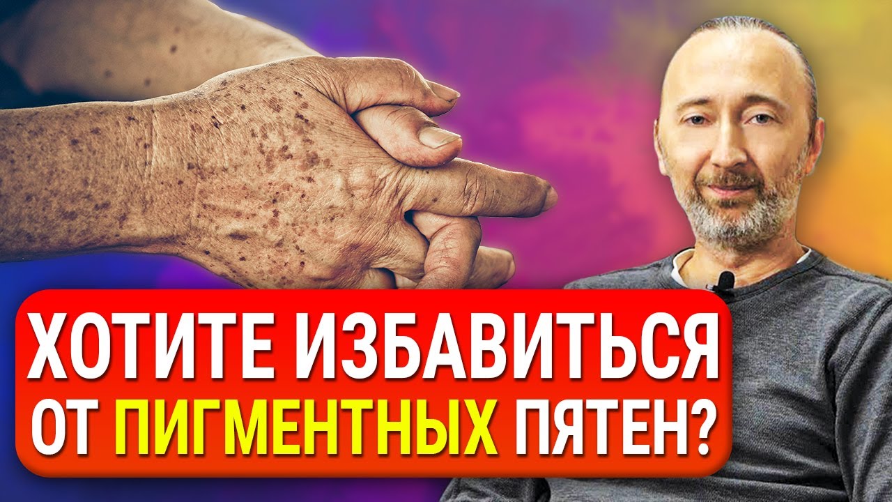 Как избавиться от пигментных ПЯТЕН на лице и теле? Причины появления. Старческие пигментные пятна.