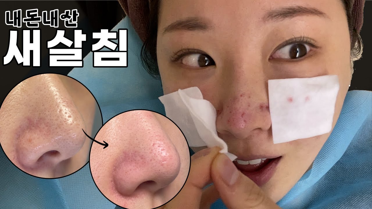 새살이 솔솔~? 모공, 흉터 시술💉새살침 상담부터 시술과정 전후사진까지 (대받녀)