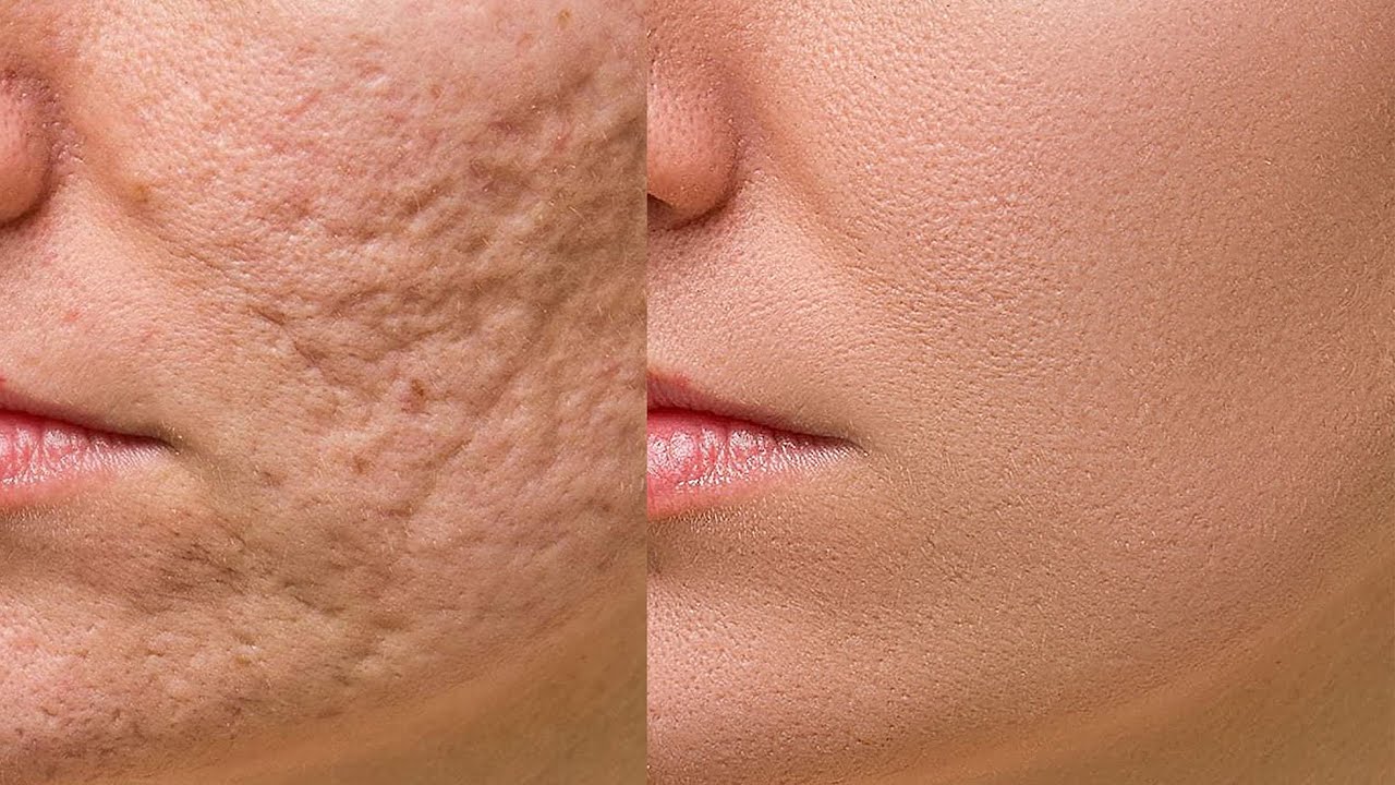 High-End Skin Retouching Beginner Photoshop Tutorial | Frequency Separation