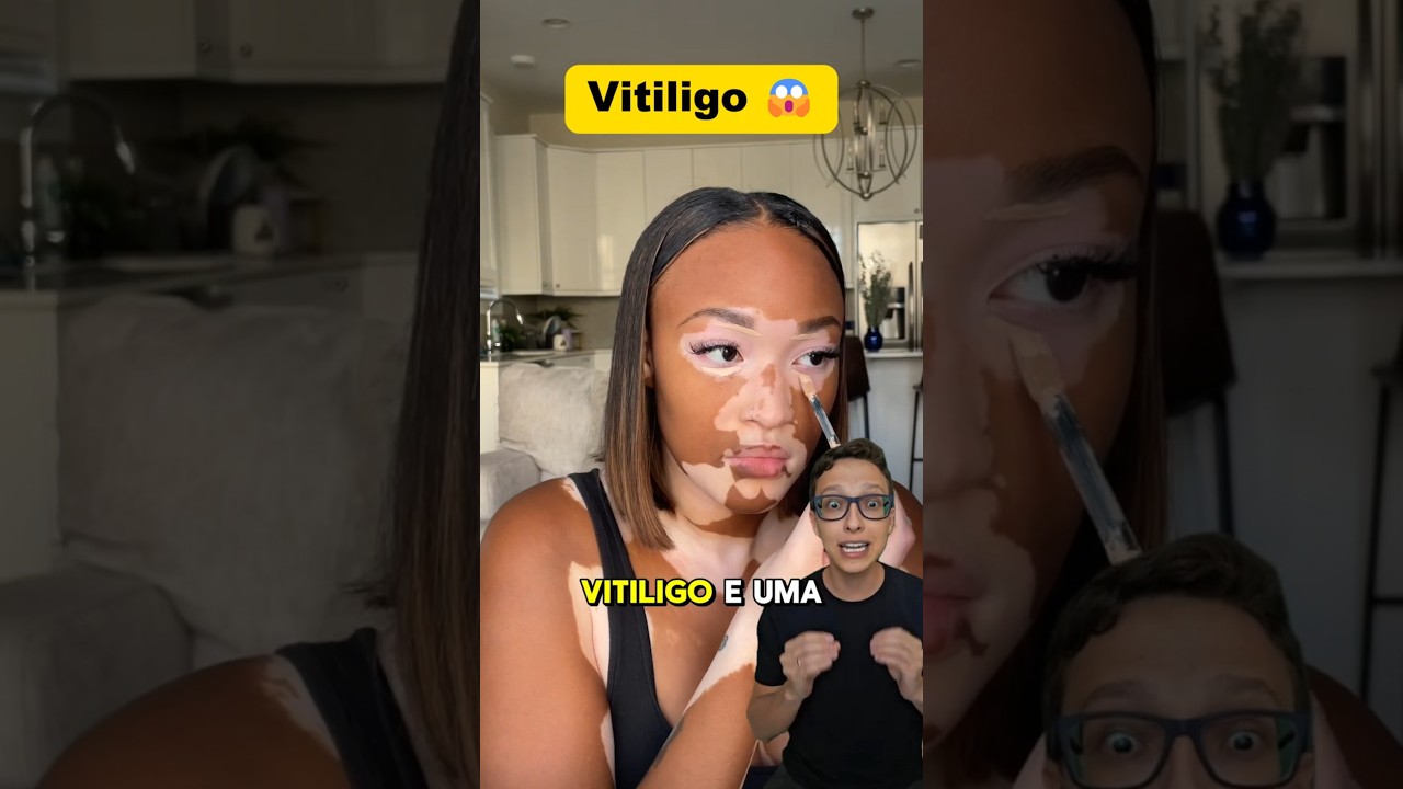 Vitiligo 😱 