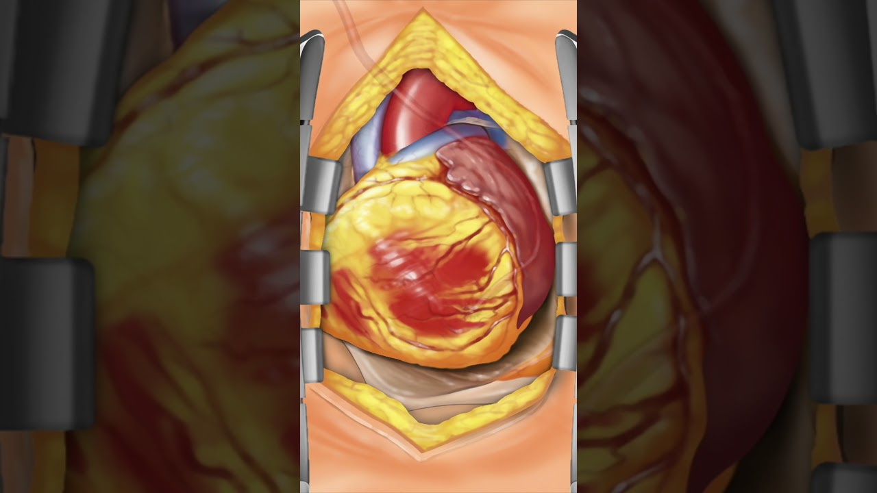 👨&zwj;⚕️🚑 Revolutionary Heart Bypass Surgery Explained! #shorts #preop #HeartHealth | PreOp&reg; Patient Ed