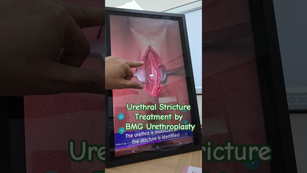 How BMG Urethroplasty is done for Urethral Stricture.