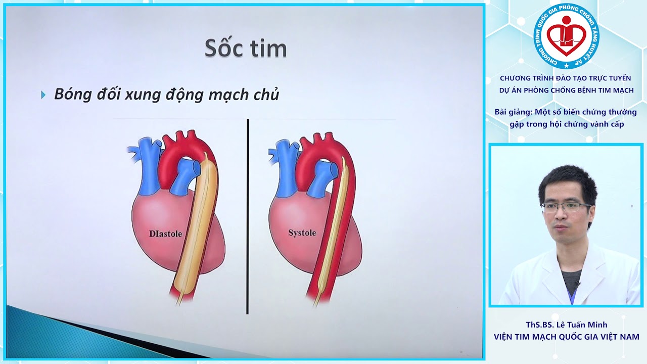 Một số biến chứng thường gặp trong hội chứng vành cấp