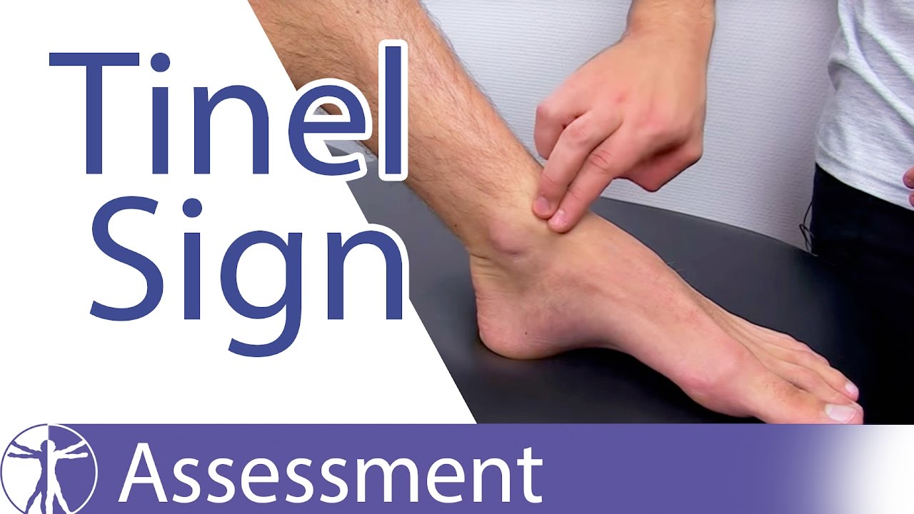 Tinel's Sign (Ankle)⎟Peripheral Nerve Injury