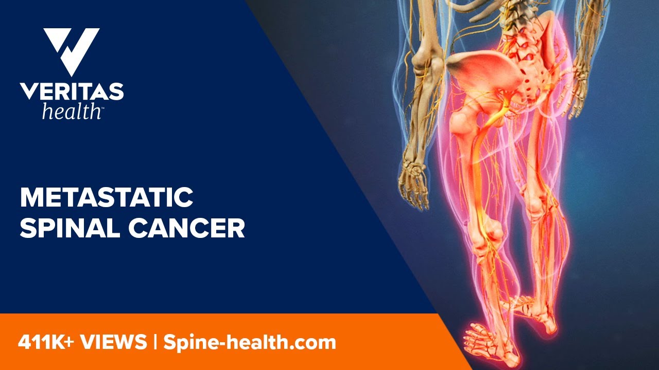 Metastatic Spinal Cancer