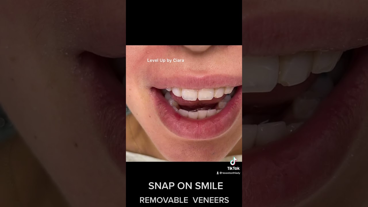 Houston Cosmetic Dentist...When you think it's Veneers but it's not! An Affordable alternative!!