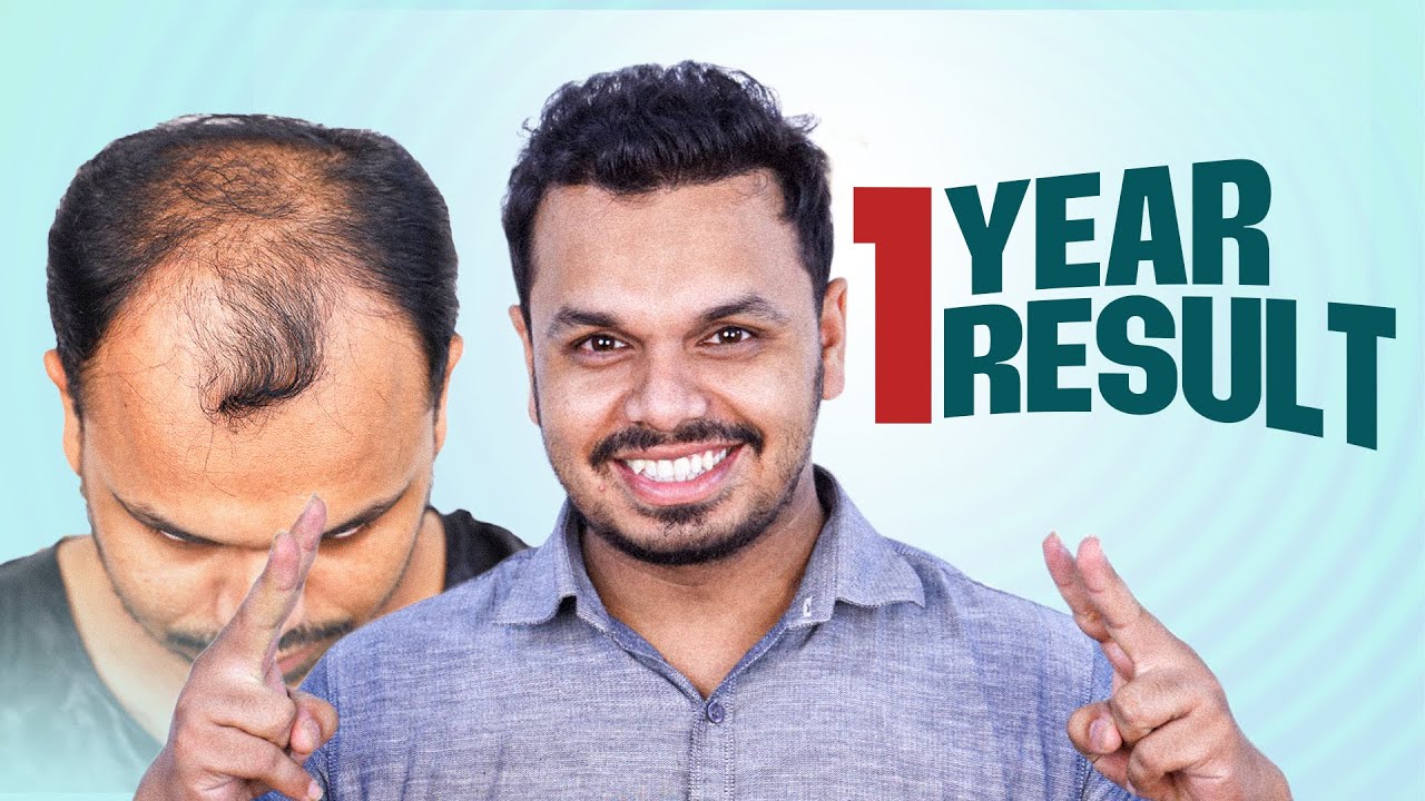 From Bald to Bold: Grade 5 Baldness Conquered 😍 | Hair Transplant Bangladesh | New Roots