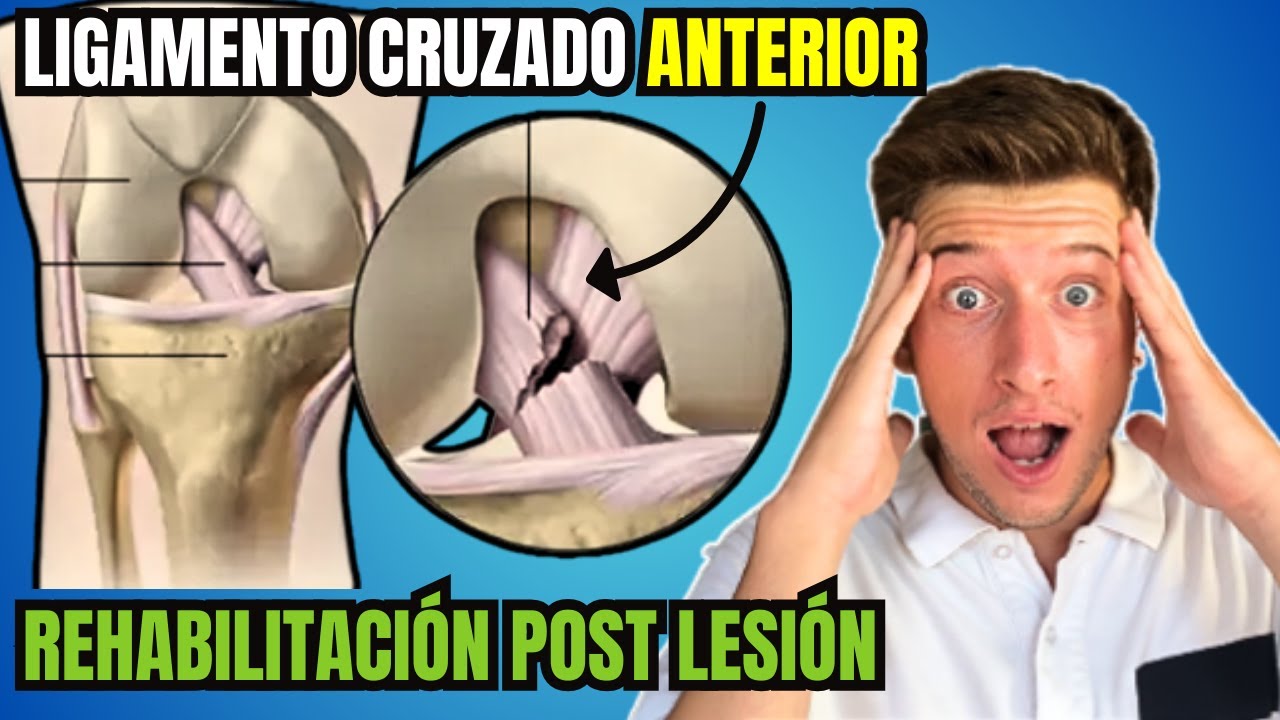 REHABILITACIÓN del Ligamento Cruzado Anterior LCA Sin CIRUGÍA (con EJERCICIOS)
