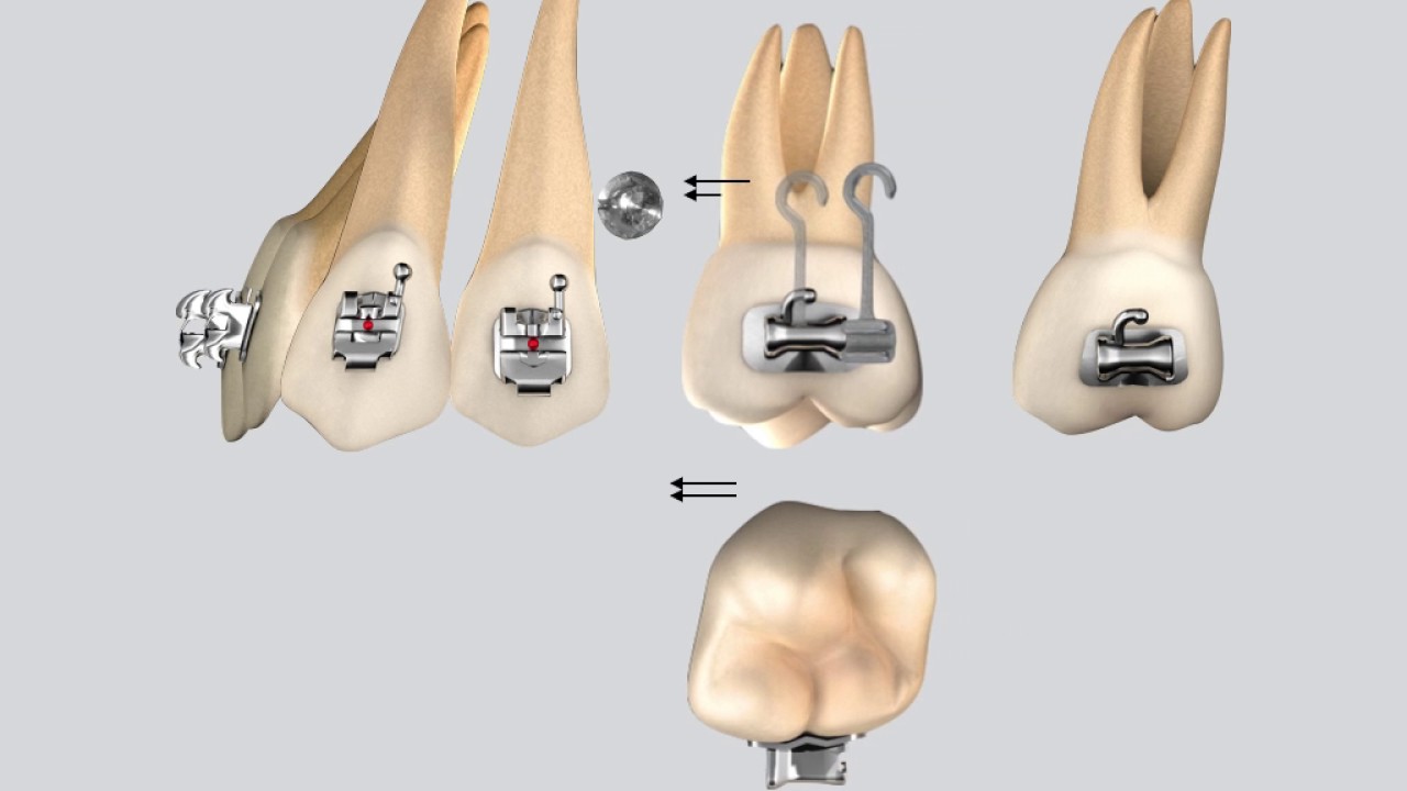Biomecánica tracción mesial de molares con mini implantes