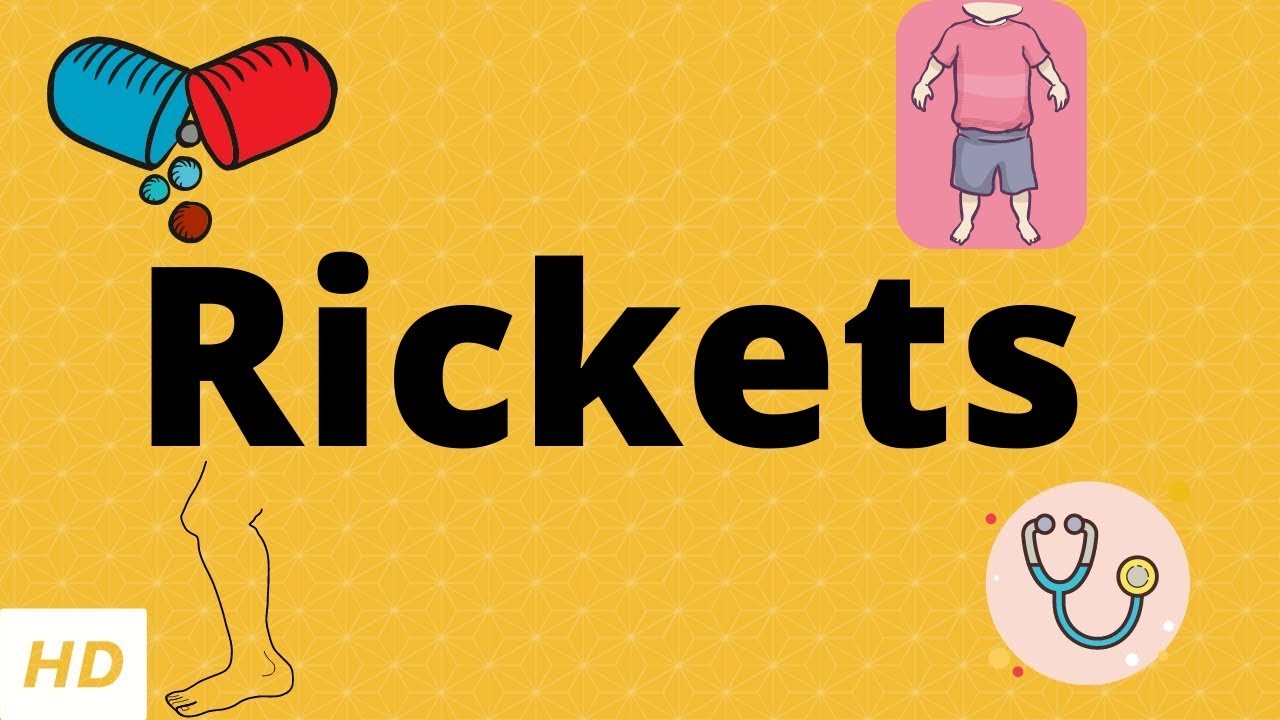 Rickets, Causes, Signs and Symptoms, Diagnosis and Treatment.