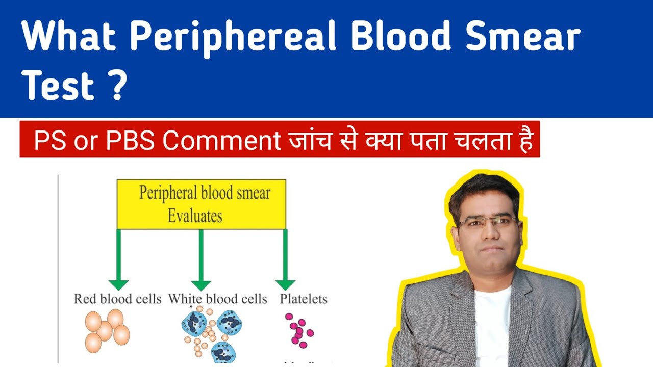 What is Peripheral Smear Blood Test ? or PS comment test | Result Interpretation