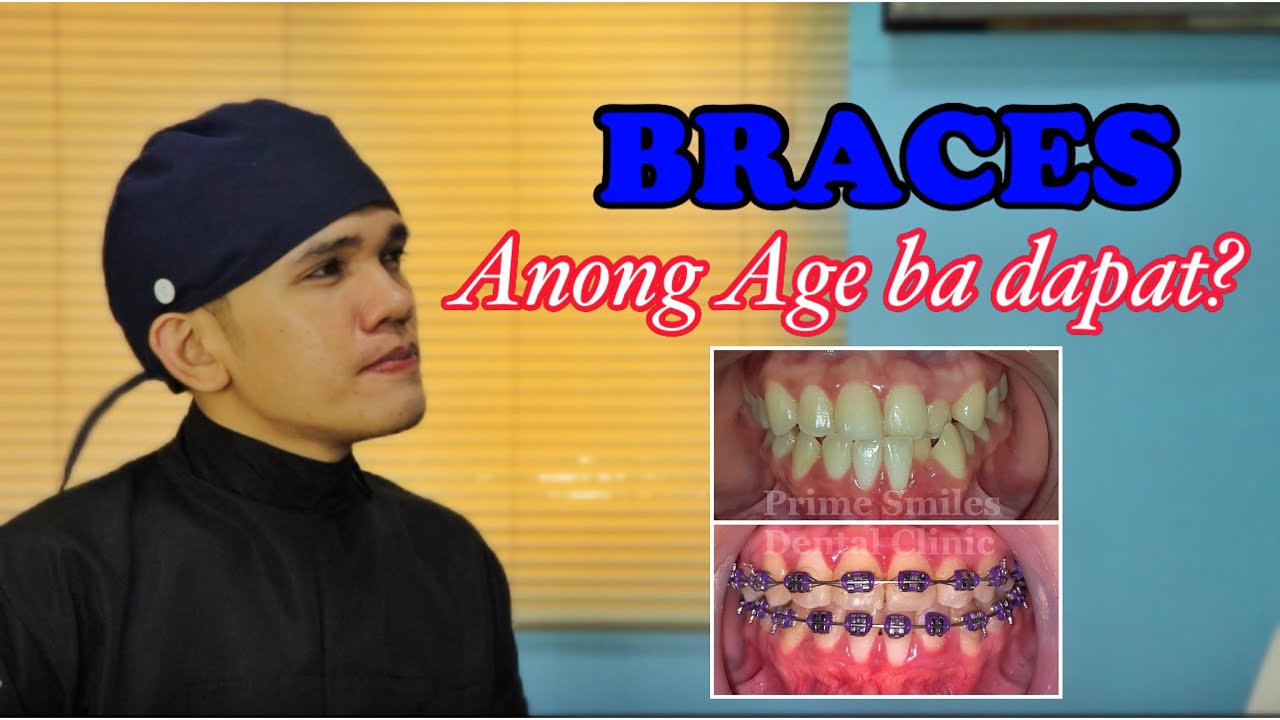 BRACES: Does Age Matter? (Anong edad ba dapat magbraces)