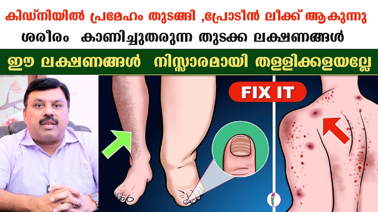 കിഡ്‌നിയിൽ പ്രമേഹം തുടങ്ങി പ്രോടീൻ ലീക്ക് ആകുന്നു ശരീരം  കാണിച്ചുതരുന്ന തുടക്ക ലക്ഷണങ്ങൾ /Dr Jeevan