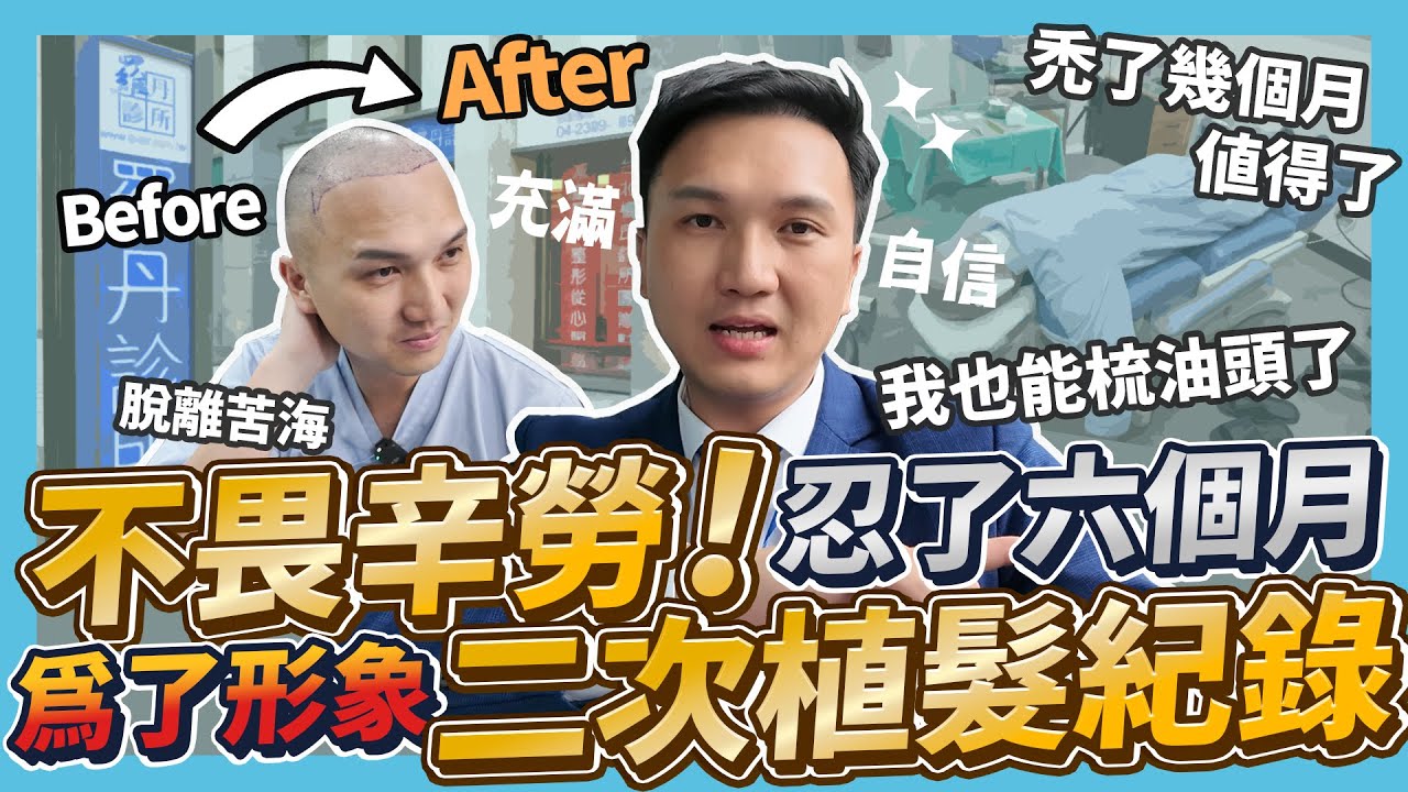 【房仲日常】又禿頭了？二次植髮全紀錄！術後 6 個月狀況如何？為了業務形象拚了！｜ ft. ‪楊氏羅丹 @jerryruok