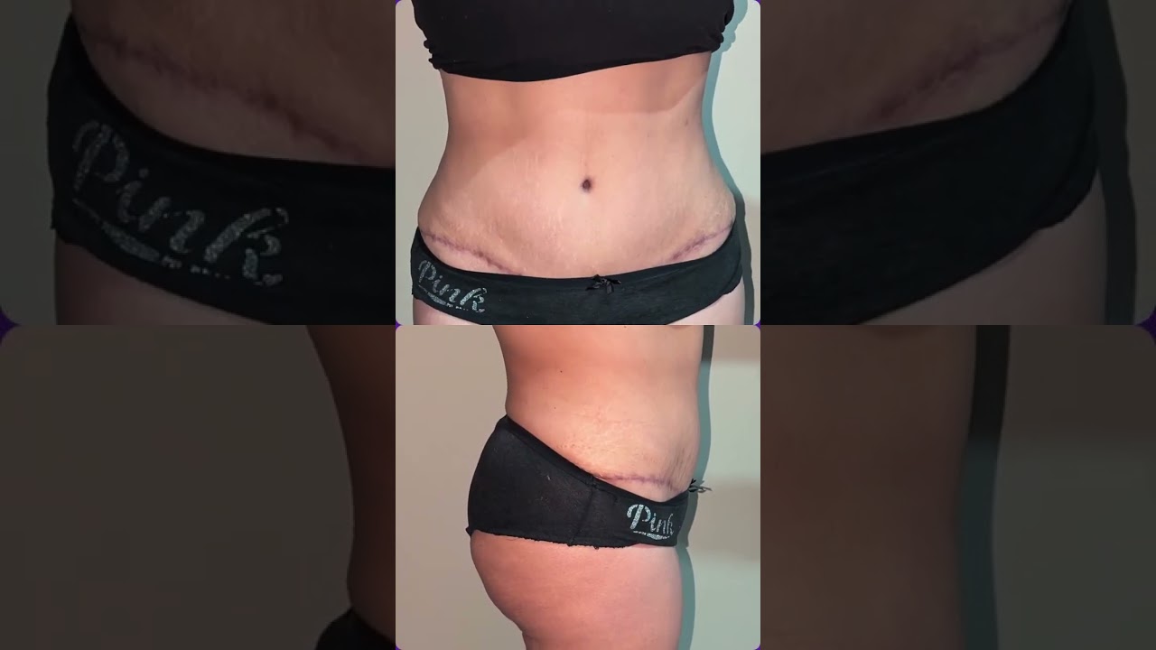 La abdominoplastia no es solo estética,es recuperar seguridad, postura Puerto Peñasco 638 125 08 45