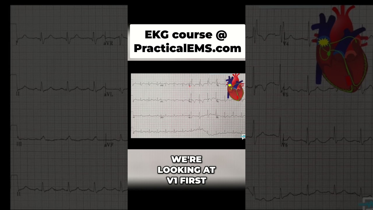 RBBB on EKG Explained: Watch This to Understand! #shorts